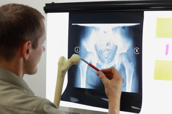 Fractura de femur - cauze, simptome, diagnostic si tratament