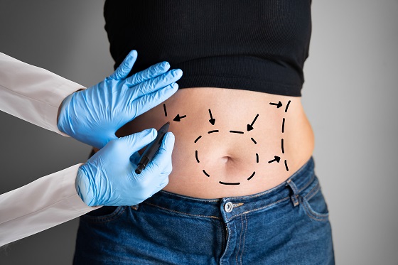 Totul despre procedura de liposuctie (lipoaspiratie) abdominala