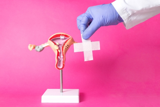 Operatie prolaps uterin: procedura si recuperare