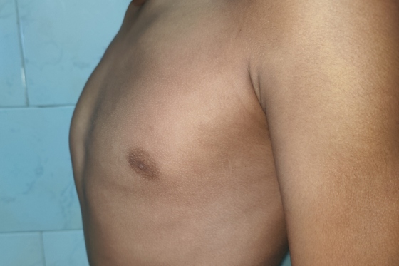 Pectus carinatum: ce este si cum afecteaza dezvoltarea toracica?