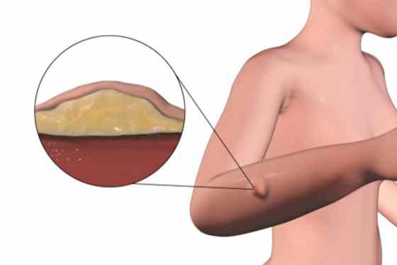 Lipomatoza – de ce apare si cand este necesara abordarea chirurgicala