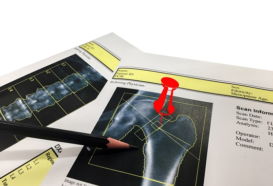 Osteopenie – cauze, simptome, plan de tratament