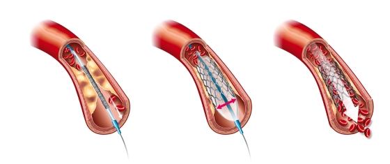 Stent la inima – informatii importante despre stentul coronarian