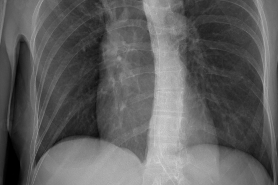 Diverticul Meckel: ce este si cum afecteaza sanatatea digestiva?