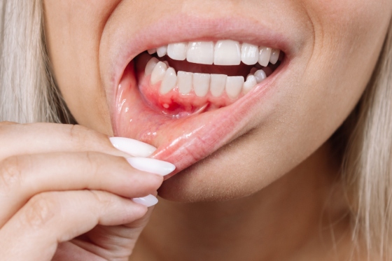 Ulcer bucal – cauze, simptome, tratament si masuri de preventie