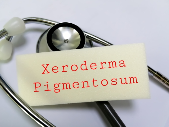 Xeroderma pigmentosum – cauze, simptome, tratament