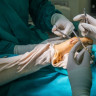 Interventia chirurgicala pentru monturi: ce trebuie sa stiti inainte de operatie