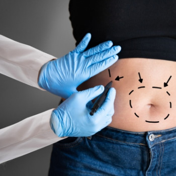 Abdominoplastie: ce este, cand se recomanda, ce beneficii are?