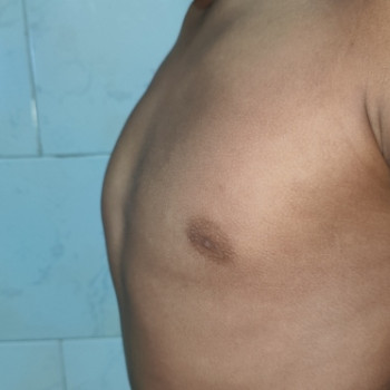 Pectus carinatum: ce este si cum afecteaza dezvoltarea toracica?