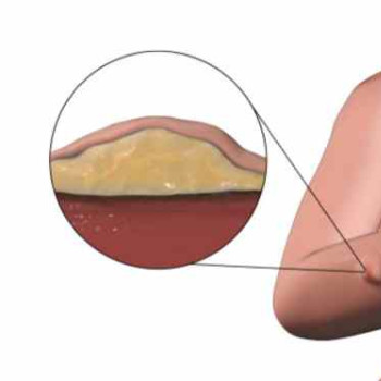 Lipomatoza – de ce apare si cand este necesara abordarea chirurgicala