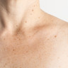 Papiloamele si cancerul de piele: legaturi si precautii
