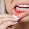 Ulcer bucal – cauze, simptome, tratament si masuri de preventie