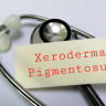 Xeroderma pigmentosum – cauze, simptome, tratament