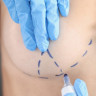 Operatia de mastopexie (lifting mamar): beneficii si riscuri