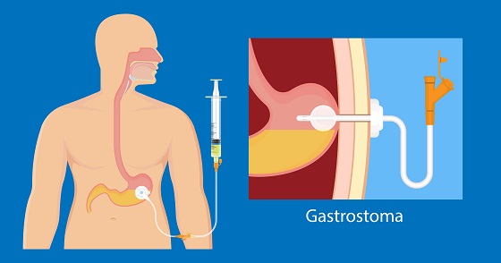 cum se monteaza gastrostoma